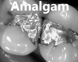 amalgam filling